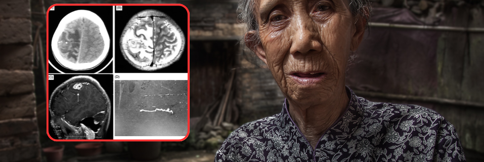 ផឹកទឹកកខ្វក់មិនដាំឆ្អិនយូរ! ស្រ្តីវ័យ ៥៦ ឆ្នាំនៅចិនត្រូវវះកាត់បើកលលាដ៍ក្បាលទាំងភ្ញាក់ដឹងខ្លួនដើម្បីយកព្រូនចេញពីខួរក្បាល - Main Article Image