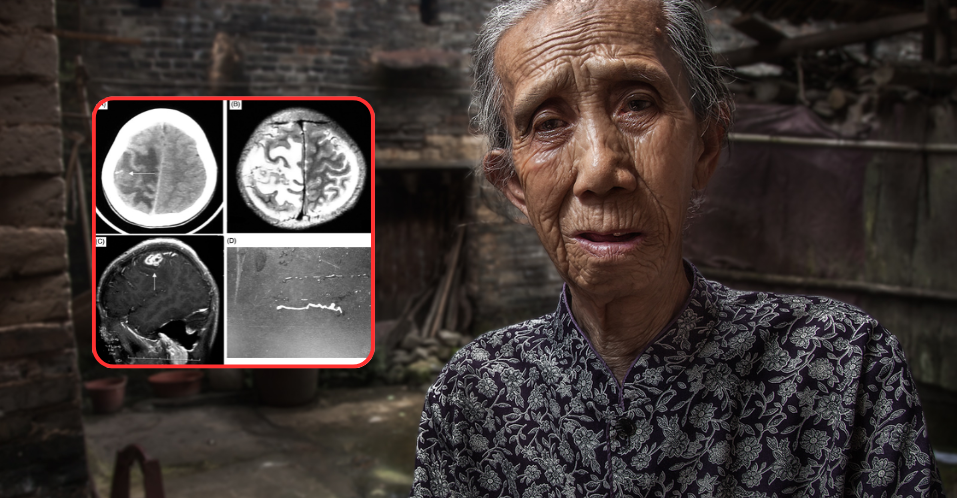 ផឹកទឹកកខ្វក់មិនដាំឆ្អិនយូរ! ស្រ្តីវ័យ ៥៦ ឆ្នាំនៅចិនត្រូវវះកាត់បើកលលាដ៍ក្បាលទាំងភ្ញាក់ដឹងខ្លួនដើម្បីយកព្រូនចេញពីខួរក្បាល